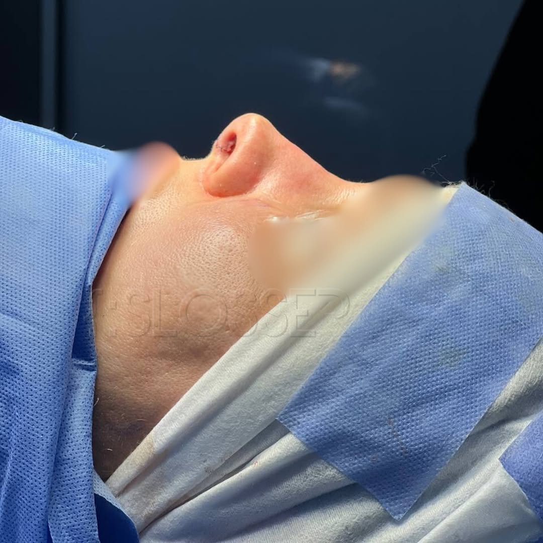 Simultaneous Plastic Surgeries: How to Go Through One Recovery Instead of Two